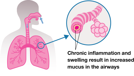 What is COPD? (Chronic Obstructive Pulmonary Disease) | COPD.com