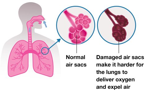 What is COPD? (Chronic Obstructive Pulmonary Disease) | COPD.com